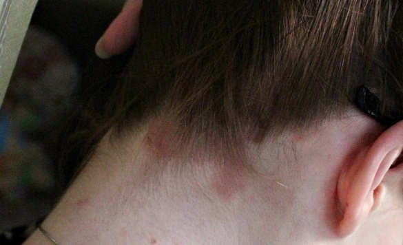 Болит кожа головы: 10 частых причин и способы избавиться от боли