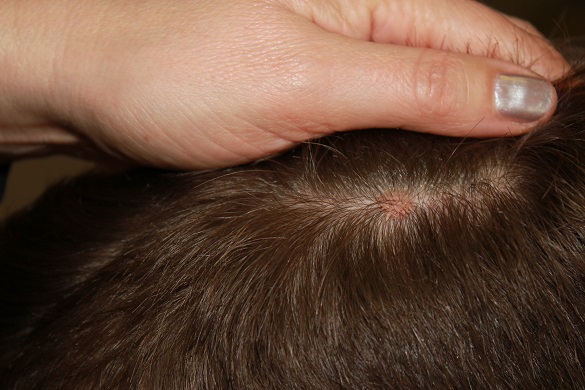 Рак кожи волосистой части головы