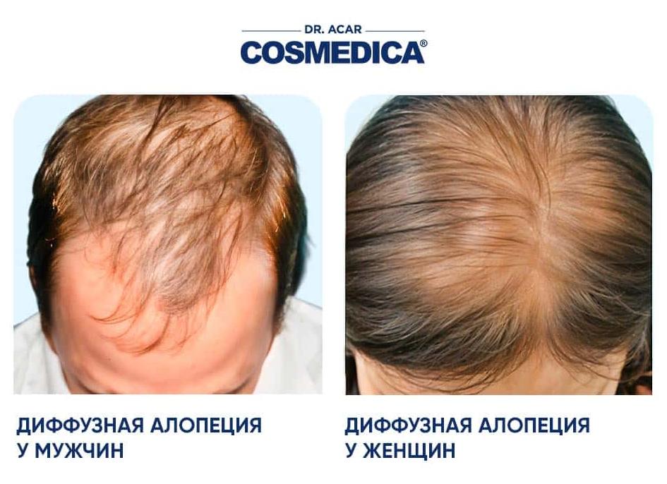 Может ли коронавирус вызвать выпадение волос?